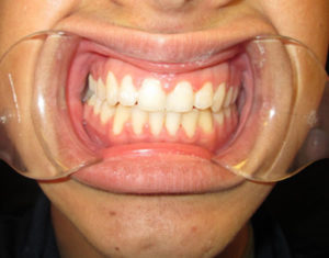 After Braces - Precision Dental Care