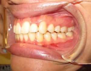 After Implants - Precision Dental Care