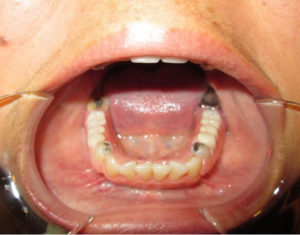 After Partials - Precision Dental Care
