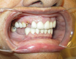 Before Bridge - Precision Dental Care