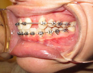 Before Implants - Precision Dental Care