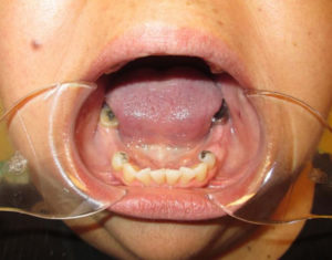 Before Partials - Precision Dental Care