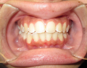 After Braces - Precision Dental Care