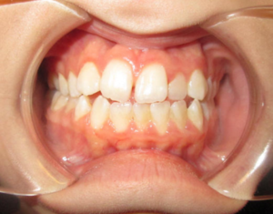 Before Braces - Precision Dental Care