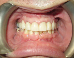Before Crown - Precision Dental Care